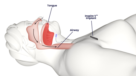 graphic depiction of airflow and device